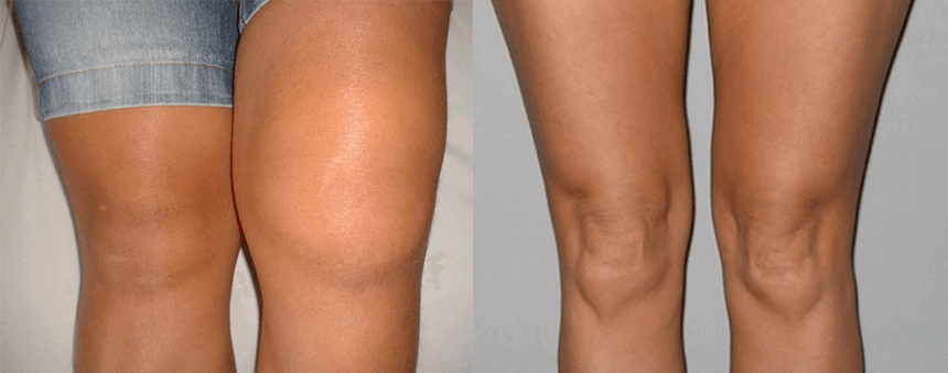 Experiência no uso de cápsulas de óleo de cannabis antes e depois do uso de Eva